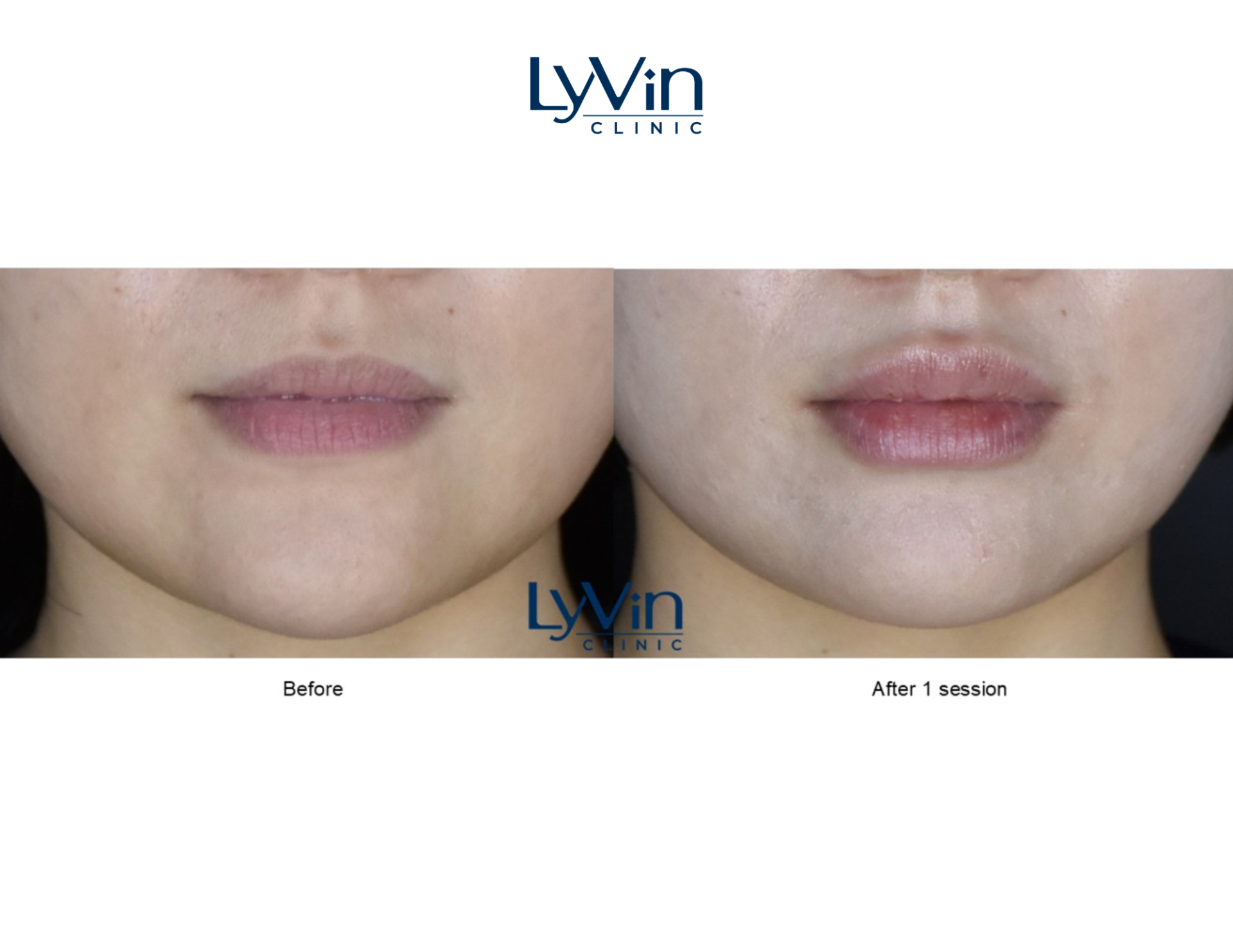 Lip Filler in Johor Bahru | Lyvin Clinic JB